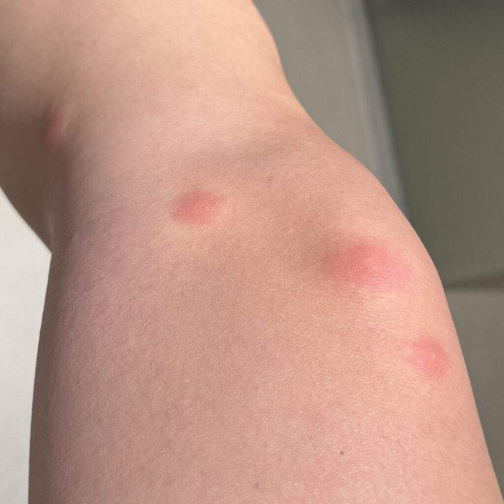 ベッドバグに刺された時の症状