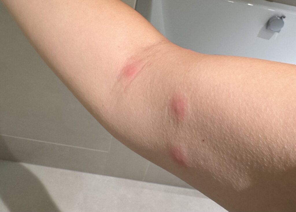 ベッドバグに刺された時の症状