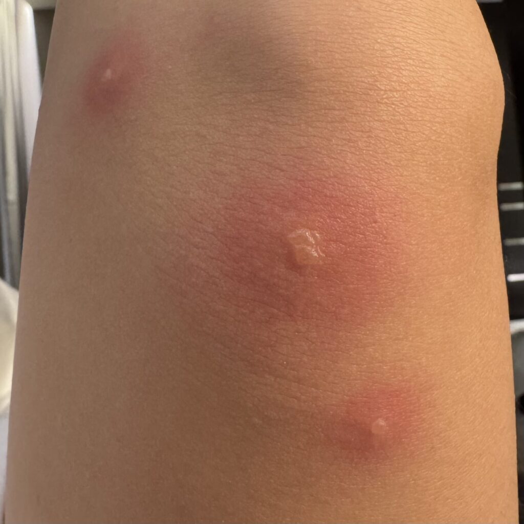 ベッドバグに刺された時の症状